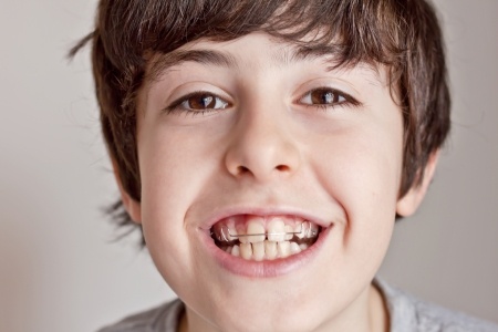 ortodoncia-niños-clinica-dental-alemana-en-torrevieja